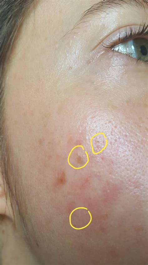 Skin Concerns Bumps Hard Plugs On My Cheeks What Are They Kp