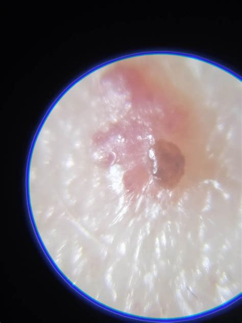 New Rigid Lump On Small Cherry Angioma 1mm On My Shoulder