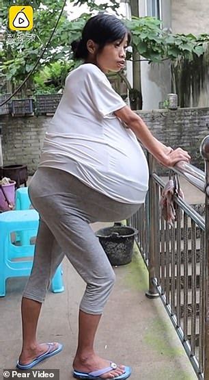 Chinese Mother Of Two Whose Belly Swelled To Pounds Uncontrollably Had To Undergo