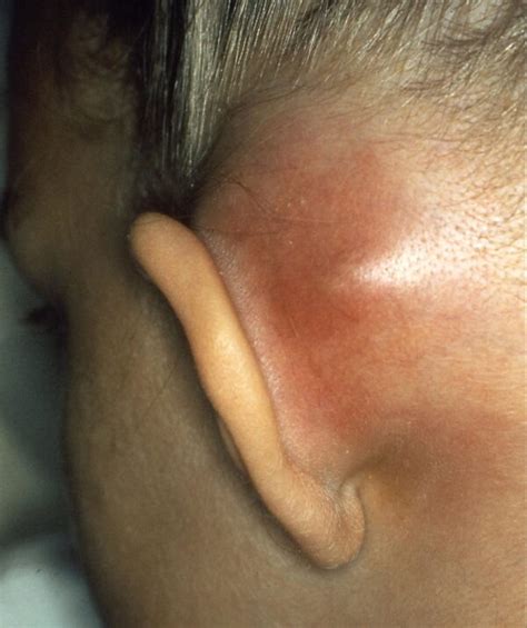 Mastoiditis Symptoms Signs Management Geeky Medics