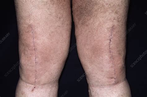 Online, article, story, explanation, suggestion. Knee surgery scars - Stock Image - M332/0073 - Science ...