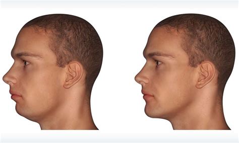 Jaw Surgery Park Avenue Oral And Facial Surgery