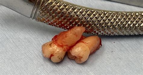 wisdom and third molar conjoined album on imgur