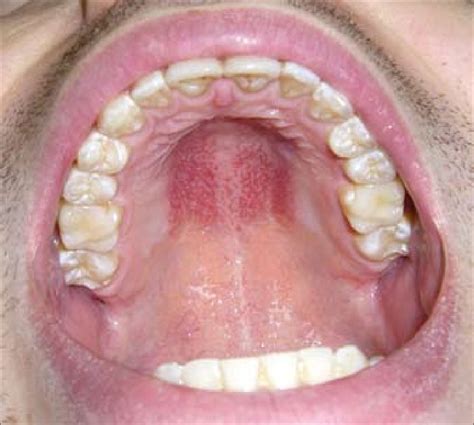 A Well Delineated Erythematous Lesion Is Observed In The Palate The