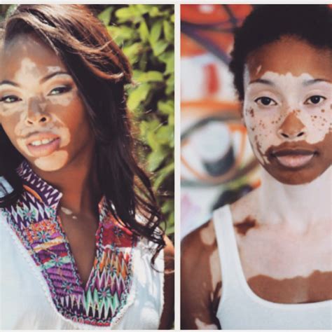 Vitiligo Skin Condition What Causes It Read About It Here Mimi