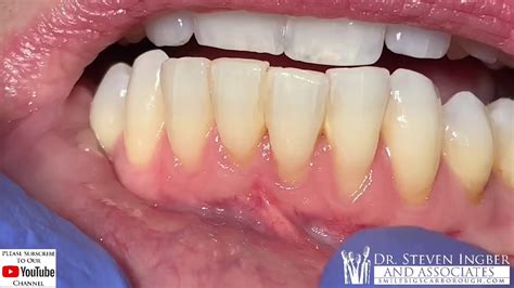 Trauma and periodontal disease can sometimes cause the gum grafts & prf treatments locally in la. Rationale for gum graft procedure - YouTube