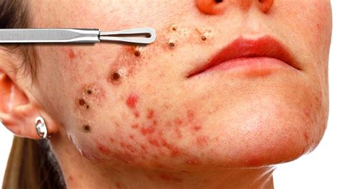 Acne Papules Causes Treatments Natural Remedies Dos And Donts