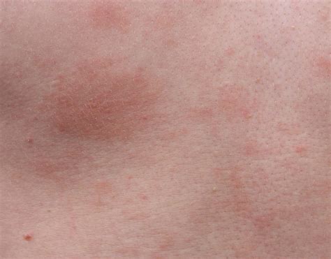 What Is Roseola Infantum With Pictures