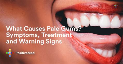 What Causes Pale Gums Symptoms Treatment And Warning Signs