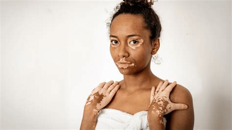 Vitiligo On Lips How To Treat White Patches On Lips Clinikally