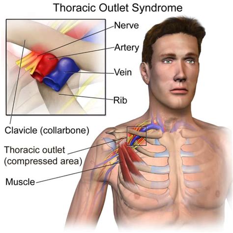Thoracic Outlet Syndrome Physical Therapy Web