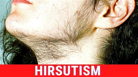 What Is Hirsutism Symptoms Causes Treatment Youtube