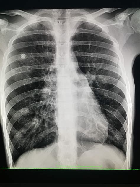 Late Diagnosis Of Cystic Fibrosis A Case Based Radiological Approach