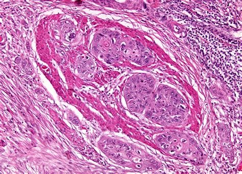 Esophageal Carcinoma At 10x Magnification Nikons Microscopyu