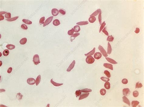 Sickle Cell Anaemia Light Micrograph Stock Image C0208172