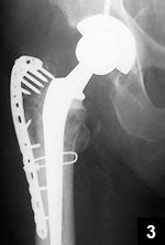 The Use of Locking Plates for Greater Trochanteric Fixation