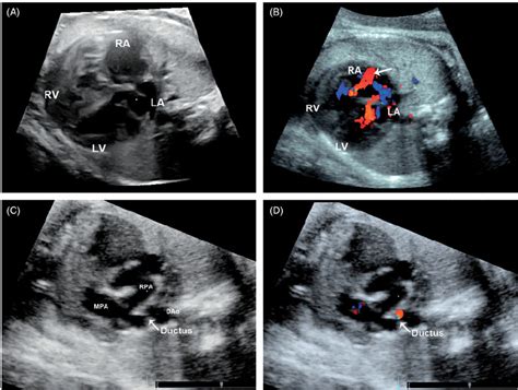 Case 18 With Constriction Of The Fetal Ductus Arteriosus Related To