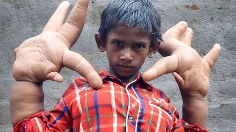 Boy With The Worlds Biggest Hands Measuring 33cm Has Surgery To