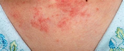 What Does Eczema Look Like When It Starts