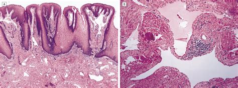 Management Of A Giant Lymphatic Malformation Of The Tongue