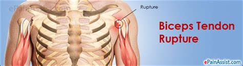 Biceps Tendon Rupture Treatment Exercise Types Causes