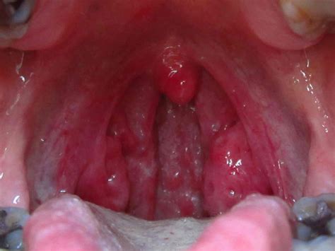 How To Get Rid Of White Spots On Tonsils Archives Viewhealthy