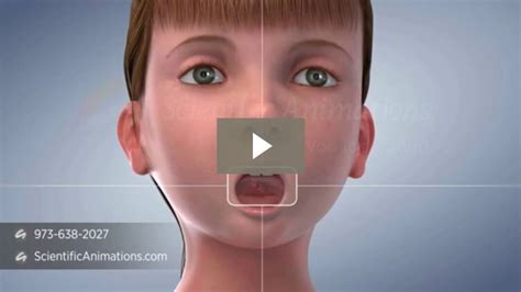 Tonsillectomy And Tonsillitis Explained Via 3d Medical Animation