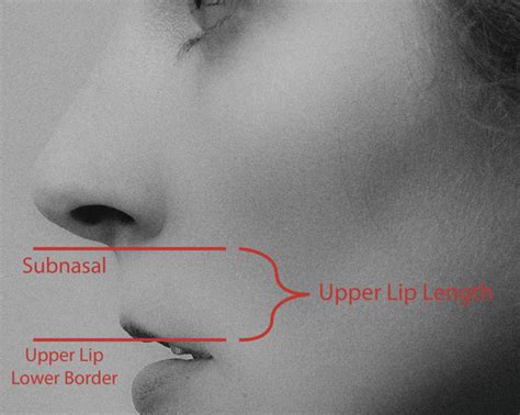 Figure Example Of Upper Lip Length Measurement Contributed By Rian