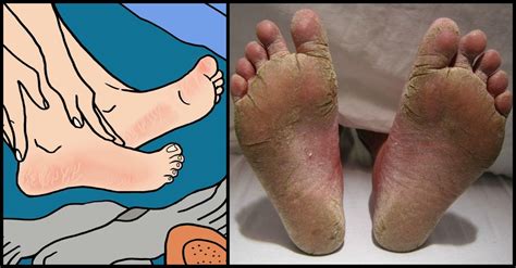 Cracked Feet 7 Alarming Reasons The Skin On Your Feet Might Be Rough
