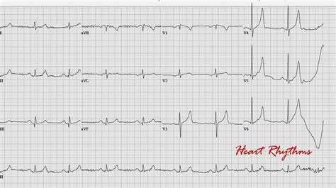 Ecg Rhythms Tented T Waves Of Hyperkalemia Images And Photos Finder
