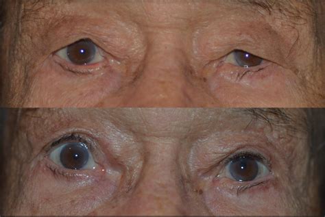 The Best Eyelid Surgery Procedure In Denver