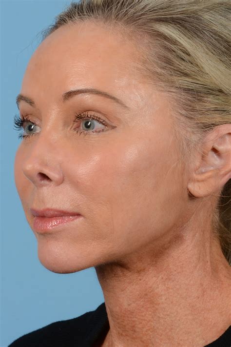 Before And After Neck Lift And Laser Skin Resurfacing And Brow Lift