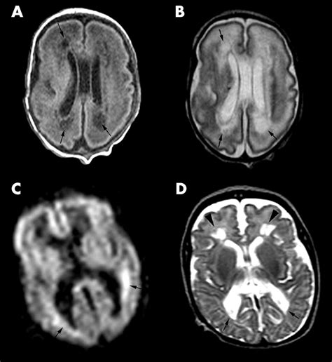 Magnetic Resonance Imaging Of Preterm Brain Injury Adc Fetal