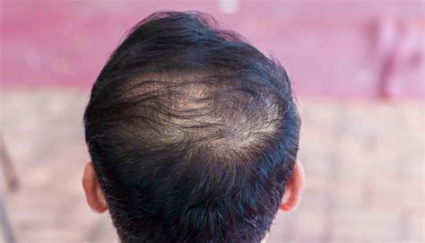 Telogen Effluvium In Men Fulham Scalp And Hair Clinic