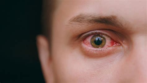 Un Hombre Se Arranca Los Ojos Bajo Los Efectos De Las Drogas Para Dejar De Ver Fantasmas