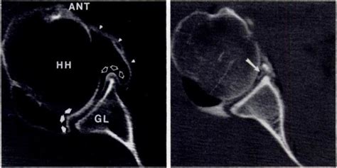 Normal Right Shoulder Ct Arthognam Anterior Glenoid Labrum Open
