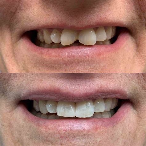 Front Teeth Fillings Before And After