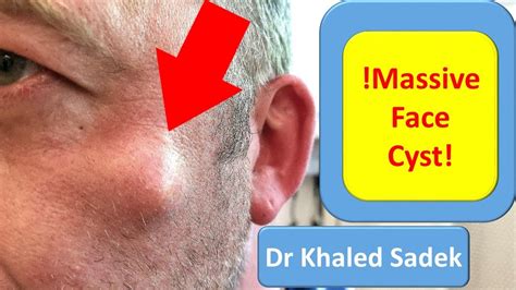 5 Year Face Cyst Cyst Removal Clinic London LipomaCyst Com Dr Khaled