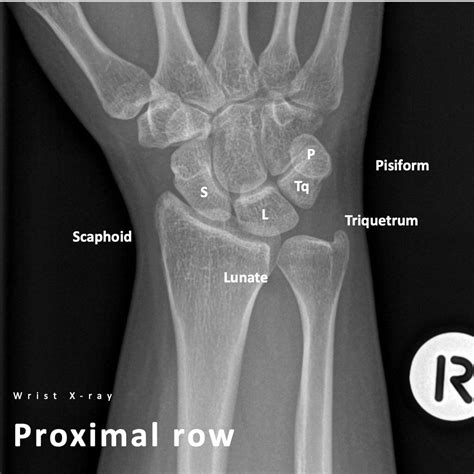 Approach To Frontal Wrist Radiograph Pulse Md
