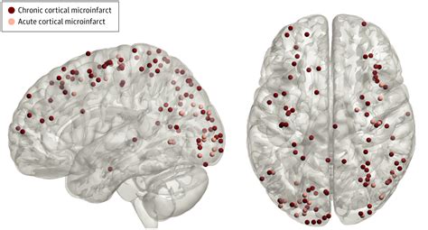 Temporal Dynamics of Cortical Microinfarcts in Cerebral Small Vessel