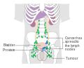 If cancer cells have spread to your lymph nodes (or beyond your lymph nodes to another part of the body), symptoms may include: File:Diagram showing prostate cancer that has spread to ...