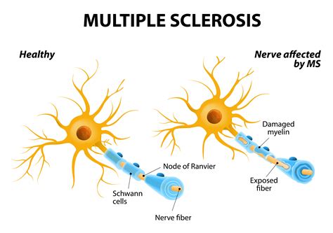 Multiple sclerosis can cause a variety of symptoms: Multiple Sclerosis :: Eye Health Central