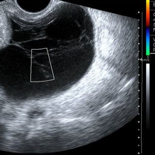 Transvaginal Ultrasound Multilocular Cystic Left Adnexal Lesion