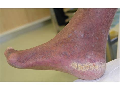 Promoting Healthy Skin 5 Diabetic Foot Ulcers A Assessment