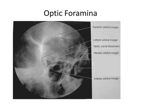 Optic Foramen Anatomy