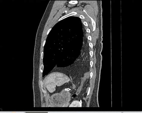 An Adult Bochdalek Hernia Presenting With Constipation And Shortness Of