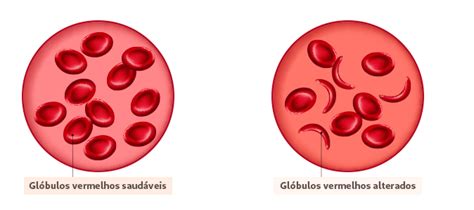 Anemia Falciforme Entenda O Que é E Como Cuidar Unimed Cariri