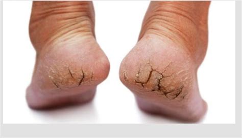 Herbal Solutions For Dry Cracked And Itchy Feet Health Gadgetsng