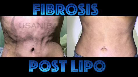 Fibrosis Post Lipo Youtube