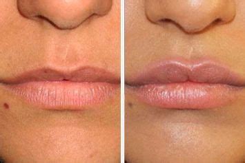 Lipofilling Face Fat Grafting Lips Wrinkles Mask